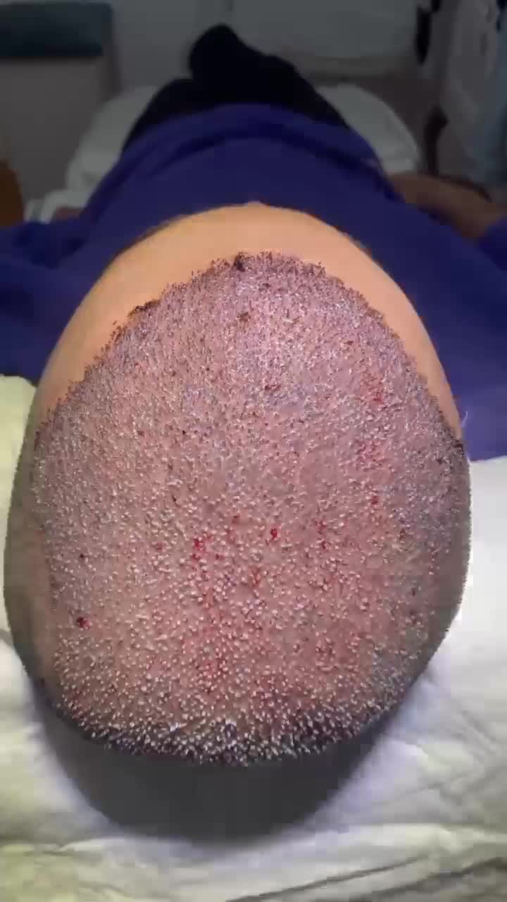 کاشت ابرو مو ریش|خدمات آرایشگری و زیبایی|گرگان, |دیوار