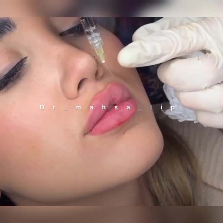 دکترمتخصص زیبایی تزریق ژل لب روسی فیلر بینی زاویه|خدمات آرایشگری و زیبایی|تهران, پونک|دیوار