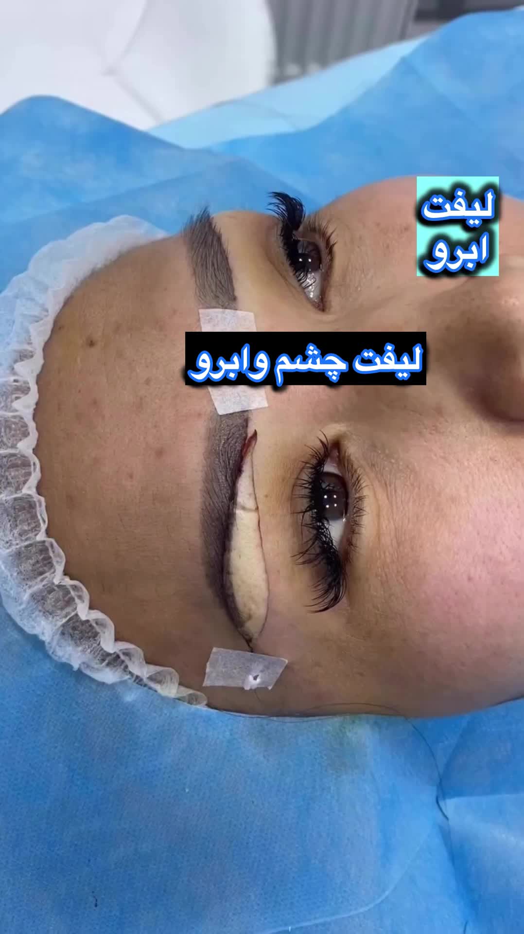 ساکشن غبغب بلفارو کاشت ابرو بوکال فت|خدمات آرایشگری و زیبایی|تهران, میرداماد|دیوار