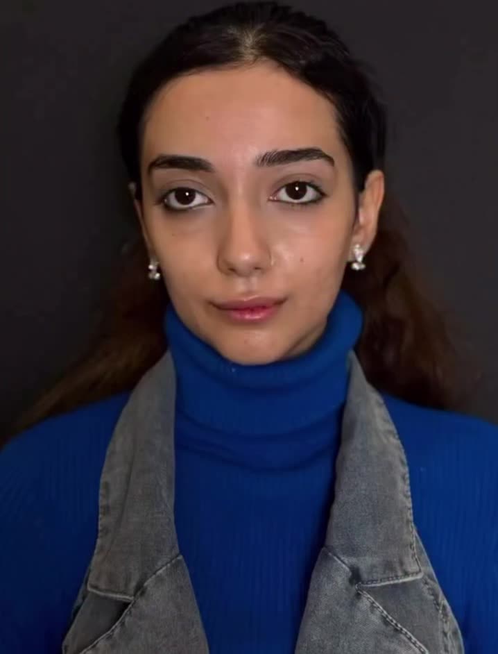 بوتاکس پیشانی،خط اخم رایگان شد توسط پزشک|خدمات آرایشگری و زیبایی|کاشان, بهشتی|دیوار