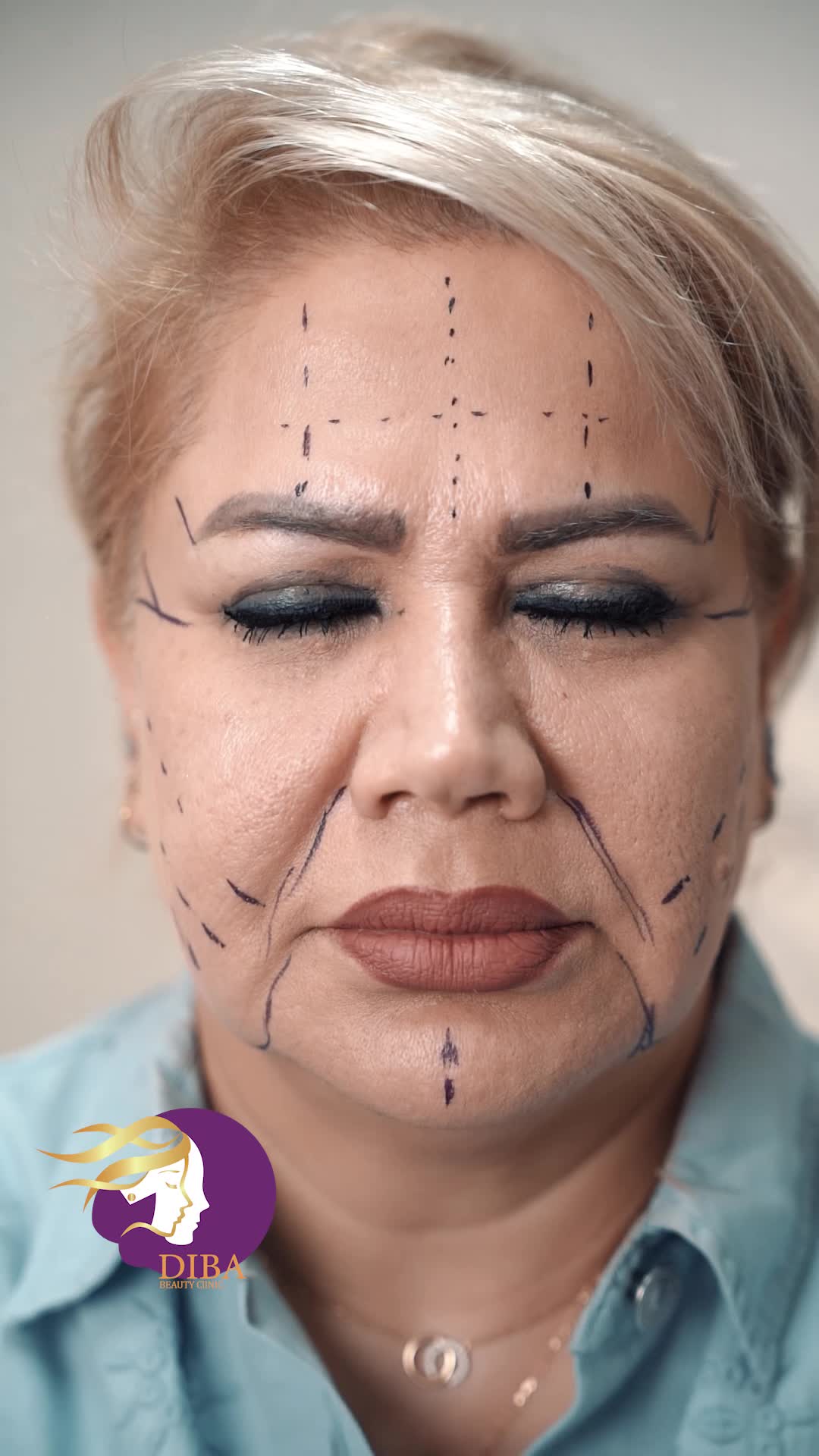 ساکشن غبغب،بلفاروپلاستی،ژل تزریق چربی+قیمت|خدمات آرایشگری و زیبایی|کرج, گوهردشت|دیوار