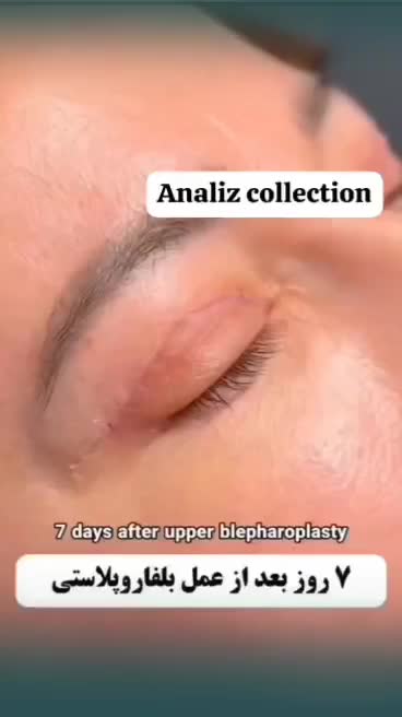 عمل بینی/پلک/غبغب/بوتاکس/پیکرتراشی|خدمات آرایشگری و زیبایی|یاسوج, |دیوار