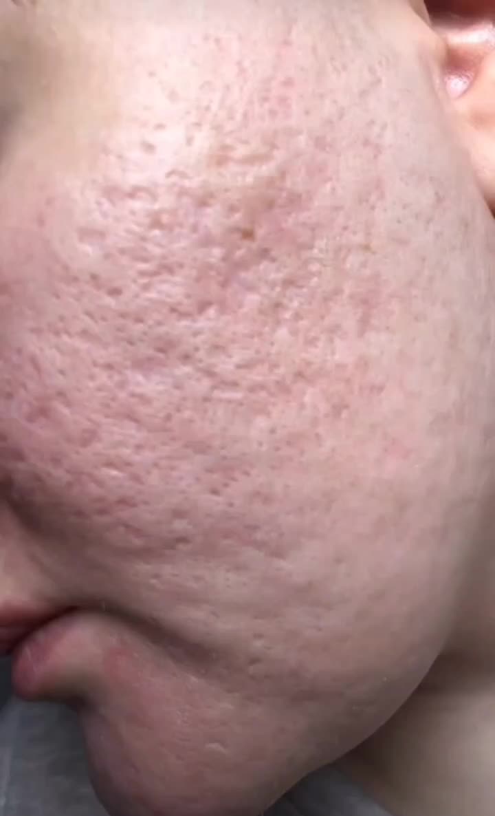 میکرونیدلینگ690 مزونیدلینگ1و300|خدمات آرایشگری و زیبایی|اهواز, نادری|دیوار