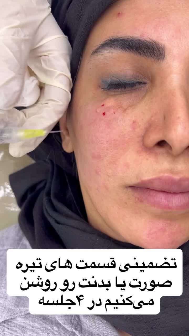 بوتاکس مصپورت۵۹۹ژل مجوزدار ۱/۲۰۰مادلینگ۵/۹۹۹|خدمات آرایشگری و زیبایی|قم, حاج زینل|دیوار