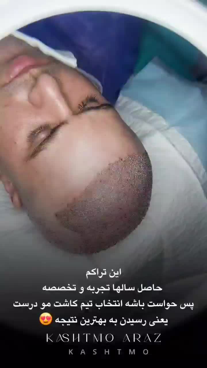کاشت مو قسطی شد|خدمات آرایشگری و زیبایی|ملکان, |دیوار