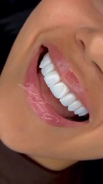 دندان مصنوعی تحویل( ۵ساعته)،کامپوزیت دندان ، روکش|خدمات آرایشگری و زیبایی|تهران, میدان ولیعصر|دیوار