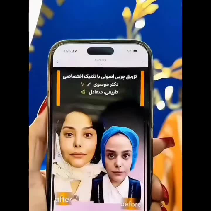 مرکز تخصصی تزریق فول فیس چربی و فیلر/لیفت با نخ|خدمات آرایشگری و زیبایی|مشهد, هنرستان|دیوار