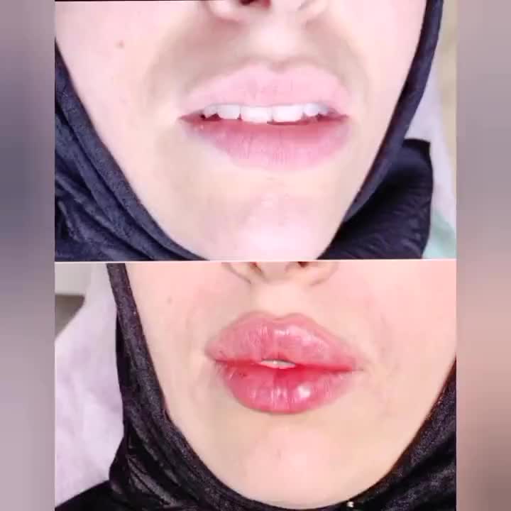 تخفیف ویژه مزو،آنزیم،ژل با بیحسی دندانپزشکی از ۴۰۰|خدمات آرایشگری و زیبایی|گرگان, |دیوار