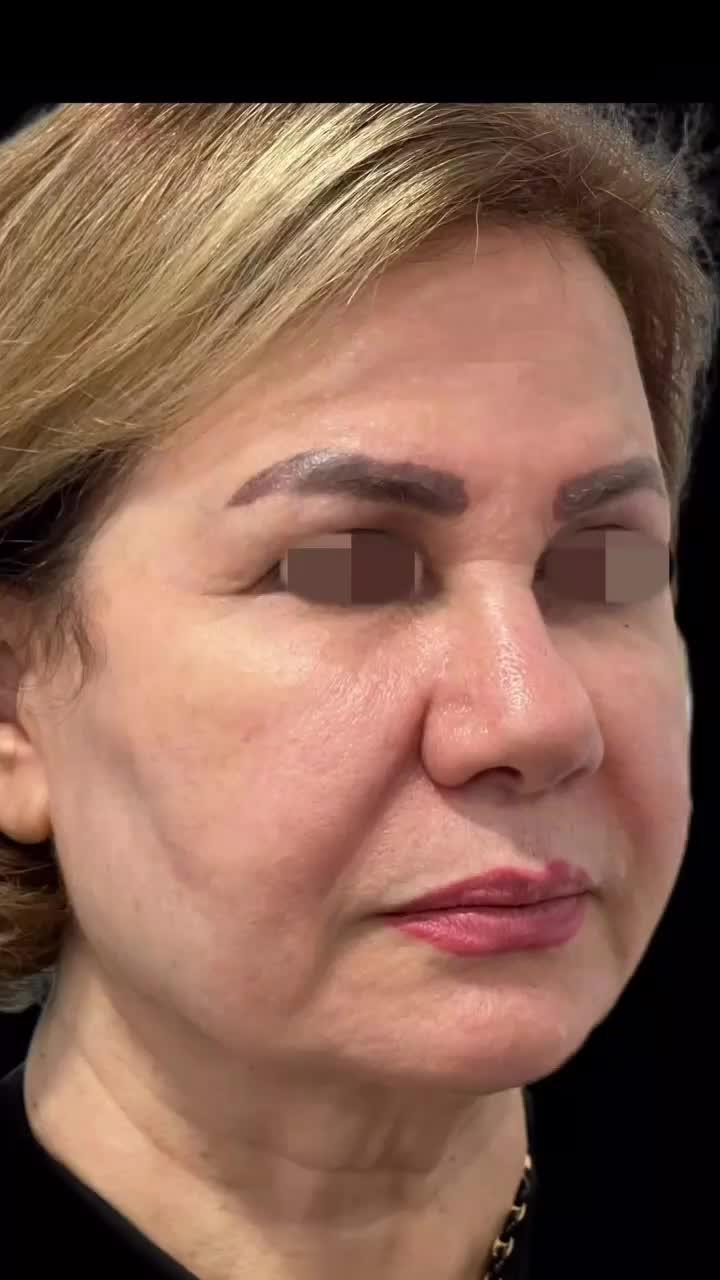 لیفت نخ صورت(بدون جراحی) در کلینیک باتخفیف50درصدی|خدمات آرایشگری و زیبایی|شاهینشهر, فردوسی|دیوار