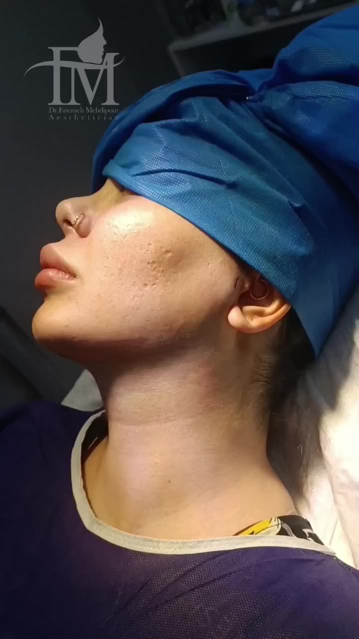 جشنواره ساکشن غبغب،بوکال فت،بلفاروپلاستی،لیپوساکشن|خدمات آرایشگری و زیبایی|اصفهان, خانه اصفهان|دیوار