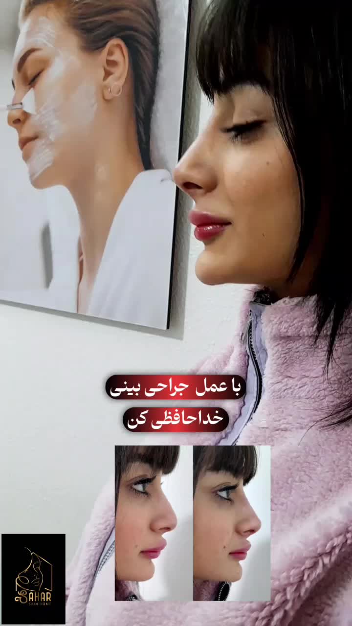 اصلاح قوزوافتادگی بینی بدون جراحی در مطب( تضمینی)|خدمات آرایشگری و زیبایی|شاهینشهر, فردوسی|دیوار