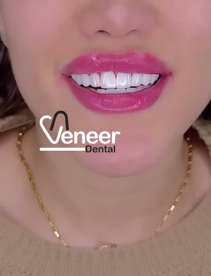 دندانیزشکی کامپوریت لمینت اینیلنت|خدمات آرایشگری و زیبایی|تهران, قیطریه|دیوار