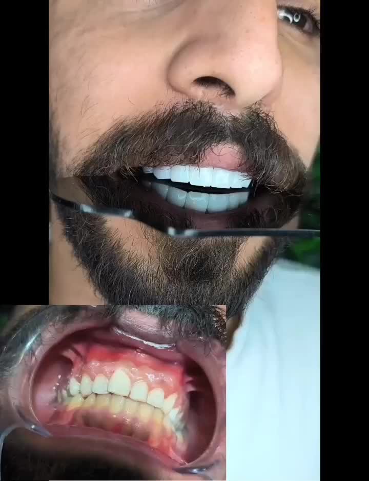 کامپوزیت دندان|خدمات آرایشگری و زیبایی|دورود, |دیوار