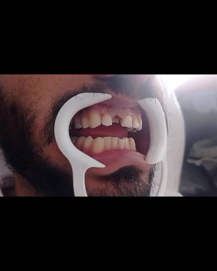 مژده مژده کامپوزیت برای یک ماه  تخفیف ویژه|خدمات آرایشگری و زیبایی|یاسوج, |دیوار