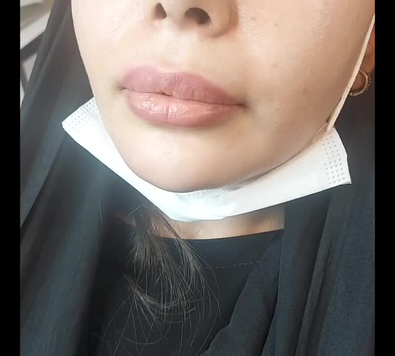 عمل لیفت ابرو وشقیقه جراحی ۸م بوتاکس مصپورت ۶۰۰|خدمات آرایشگری و زیبایی|مشهد, شهید فرامرز عباسی|دیوار