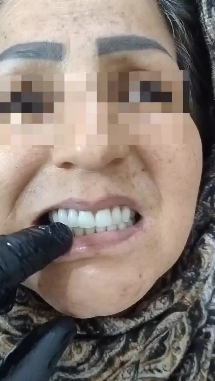 دندان مصنوعی و دندانسازی ، خدمات دندان سازی|خدمات آرایشگری و زیبایی|مشهد, شفا|دیوار