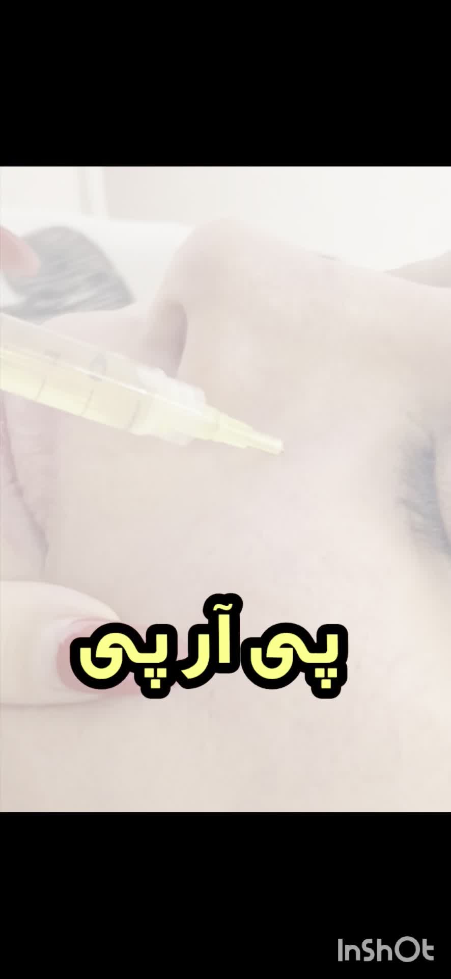 پی آر پی صورت ومو،مزوتراپی مو،پلاژن تراپی(روشن ساز|خدمات آرایشگری و زیبایی|نورآباد ممسنی, |دیوار