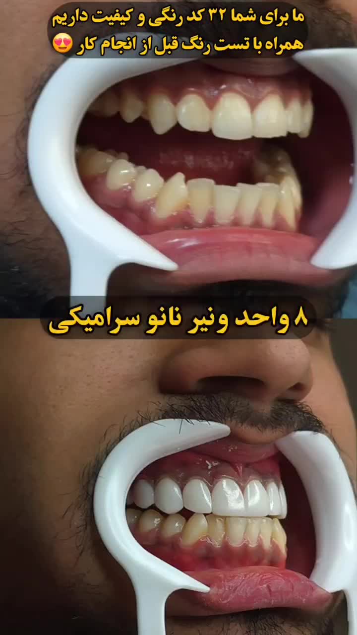 کامپوزیت از فکی ۴ تومن / بلیچینگ / بریج|خدمات آرایشگری و زیبایی|اهواز, زیتون کارمندی|دیوار
