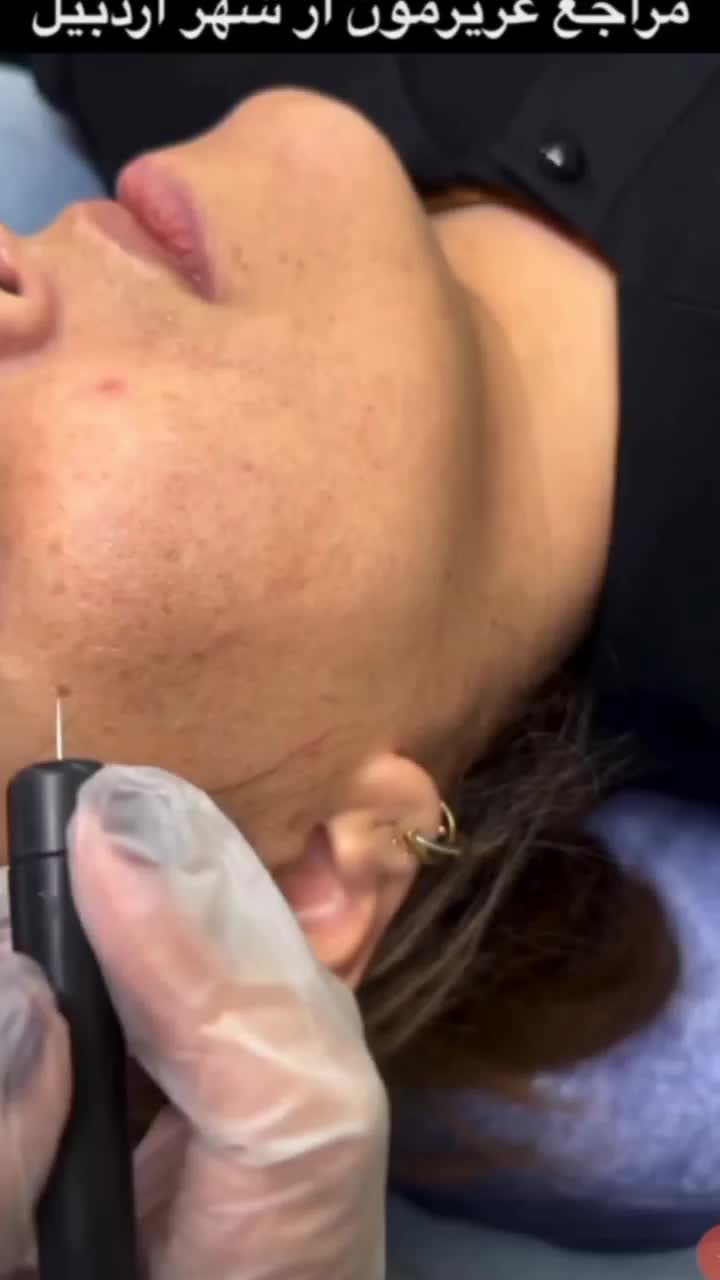 درمان تضمینی لک/کک و مک/ خال /فقط در 1جلسه|خدمات آرایشگری و زیبایی|اصفهان, لاله|دیوار