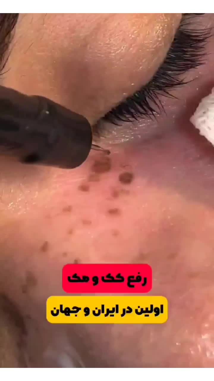 جشنوار یلدا درمان تضمینی کک ومک/لک/خال/فقط در1جلسه|خدمات آرایشگری و زیبایی|اصفهان, باغ زیار|دیوار