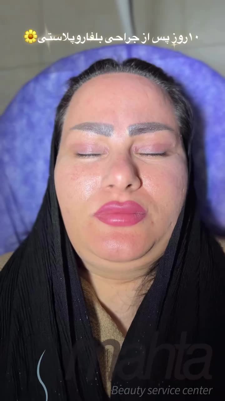 تخفیف ویژه عمل افتادگی پلک بلفاروپلاستی نقدو اقساط|خدمات آرایشگری و زیبایی|تهران, تهرانسر مرکزی|دیوار