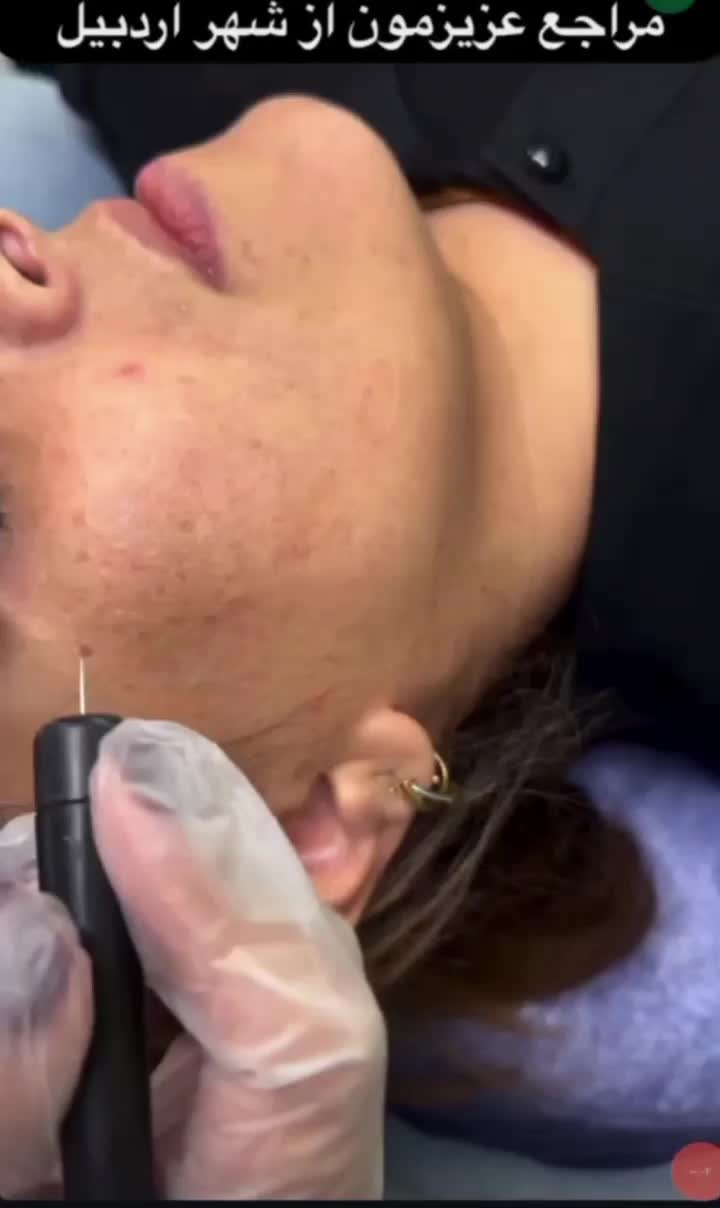 درمان و لیزر تضمینی کک و مک و لک فقط در 1 جلسه|خدمات آرایشگری و زیبایی|اصفهان, لاله|دیوار