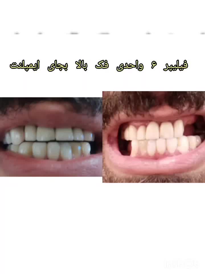 دندان متحرک مصنوعی بجای ایمپلنت فوری و سریع|آرایشی، بهداشتی، درمانی|رشت, گلسار|دیوار