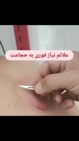 امبدینگ حجامت بادکش طب سوزنی فصد خون زالودرمانی|خدمات آرایشگری و زیبایی|اصفهان, سعادت‌آباد|دیوار