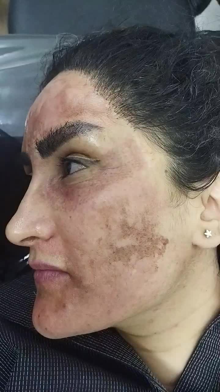 اولین درمانگرلک با متدپکینگ آپ وحذف تک جلسه کک مک|خدمات آرایشگری و زیبایی|بوشهر, |دیوار