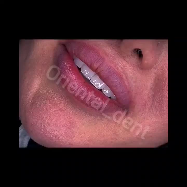 کامپوزیت دندان/دندانپزشکی/ترمیم/عصبکشی/لمینیت|خدمات آرایشگری و زیبایی|تهران, تهرانپارس شرقی|دیوار