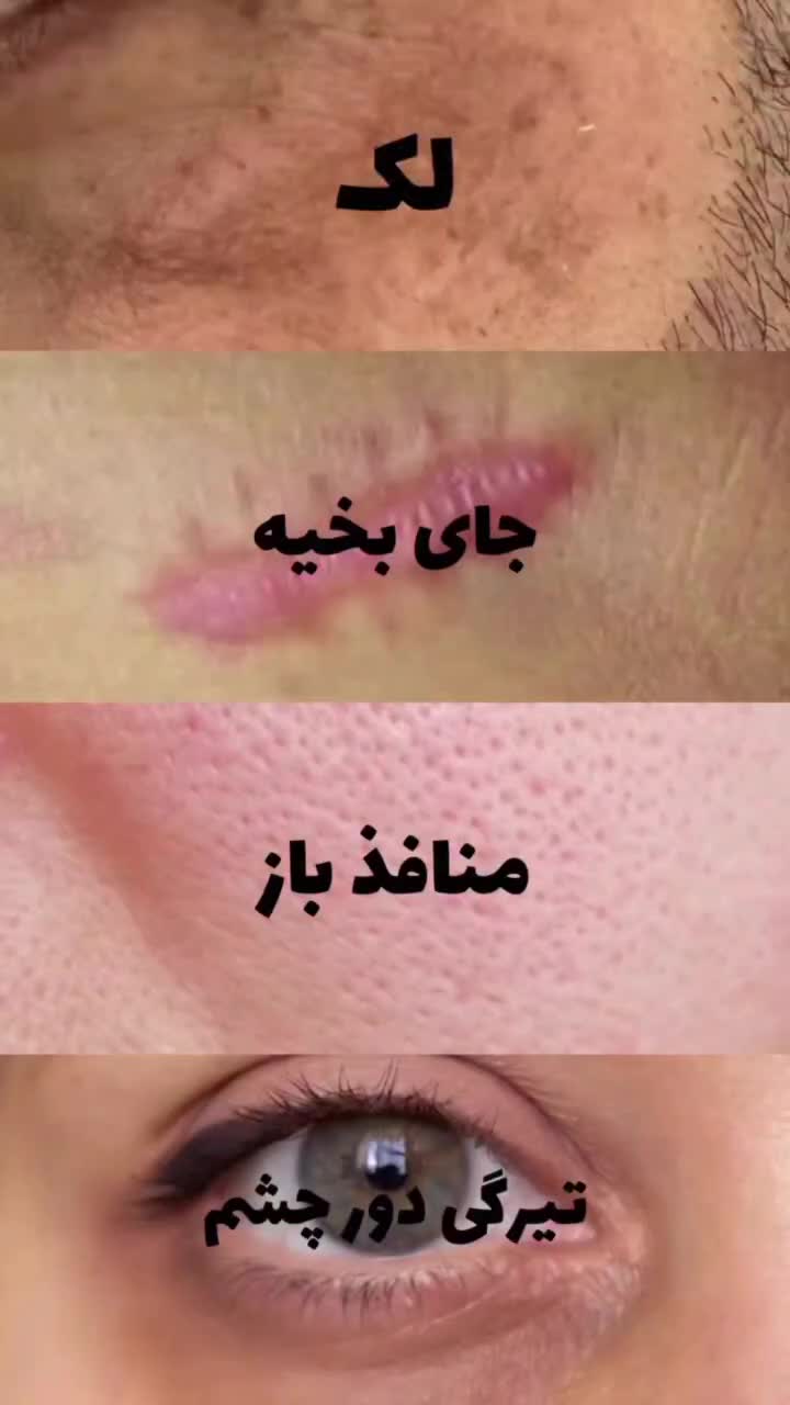 ترمیم کننده جای زخم و بخیه|آرایشی، بهداشتی، درمانی|بوکان, |دیوار