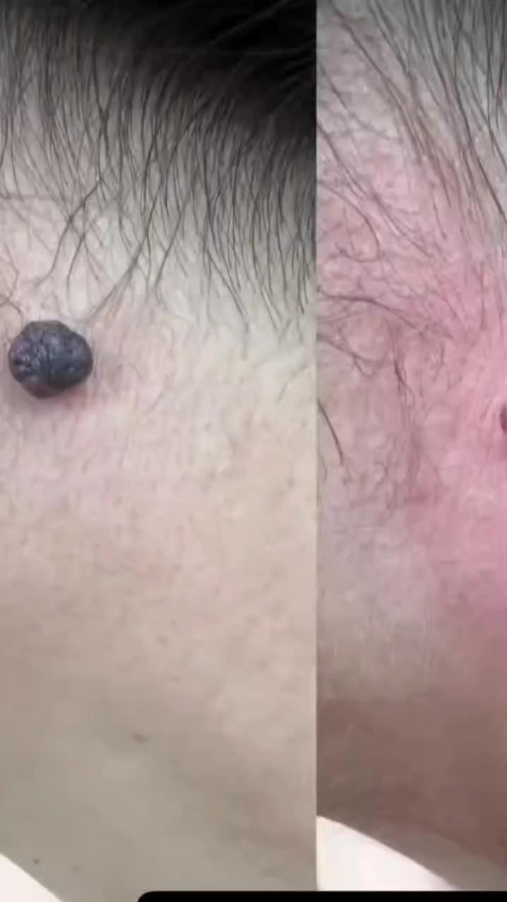 خال برداری و ضایعات پوستی در کلینیک معتبر|خدمات آرایشگری و زیبایی|کرمانشاه, |دیوار