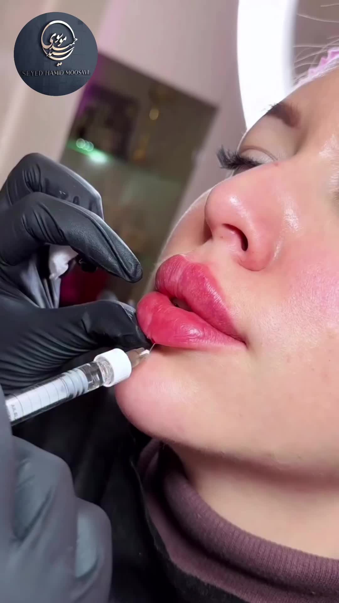 فیلر لب ژل گونه فک بوتاکس لیزرساکشن غبغب کاشت مو|خدمات آرایشگری و زیبایی|رشت, گلسار|دیوار