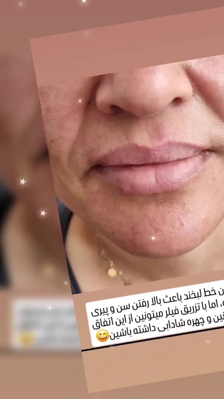 تزریقات. و جوانسازی پوست با فیلر و بوتاکس|آرایشی، بهداشتی، درمانی|اهواز, زیتون کارگری|دیوار