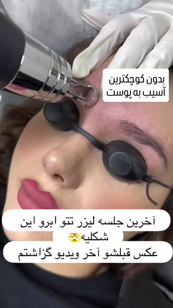 پاک کردن تاتو صورت بدن تخفیف تست رایگان|خدمات آرایشگری و زیبایی|کرمانشاه, |دیوار