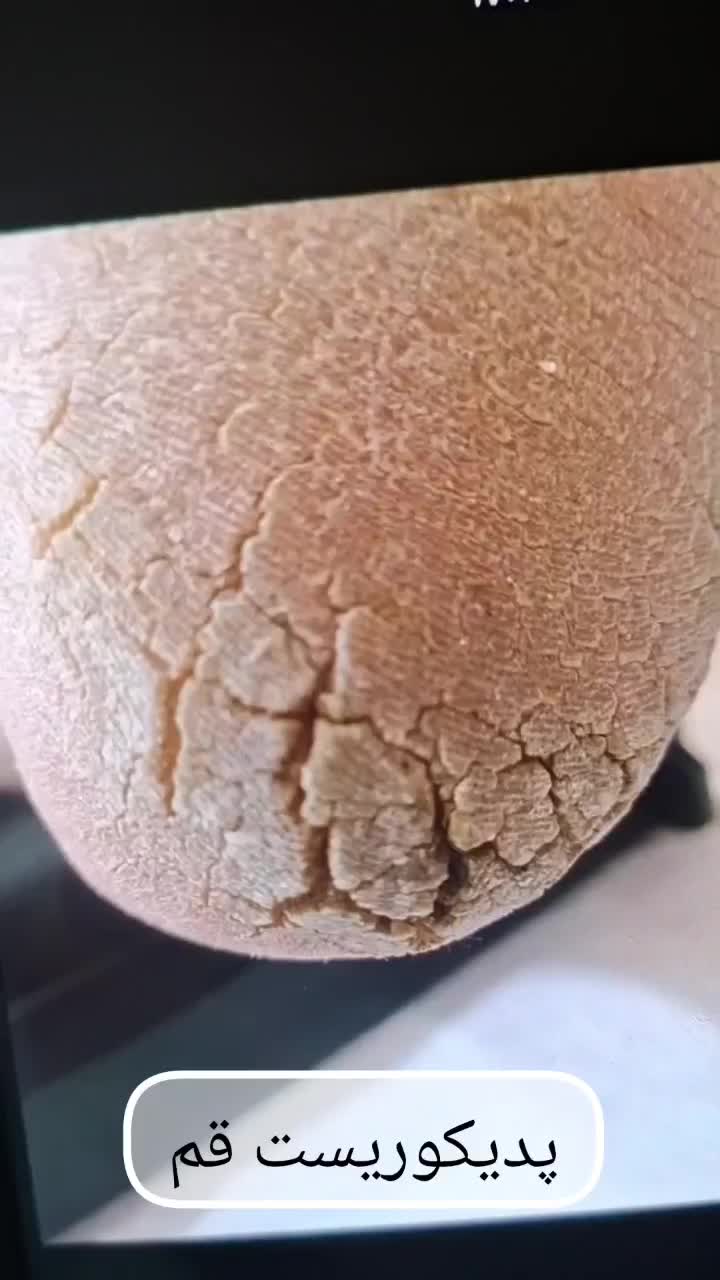 پدیکور درمانی آقایان و بانوان|خدمات آرایشگری و زیبایی|قم, دورشهر|دیوار