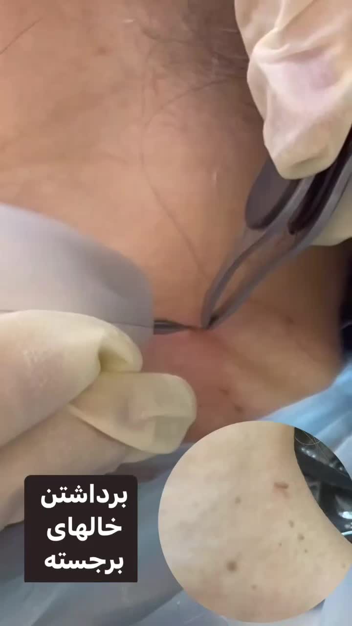 برداشتن خال ، خال گوشتی و میلیا فقط در یک جلسه|خدمات آرایشگری و زیبایی|کرج, اتحاد|دیوار