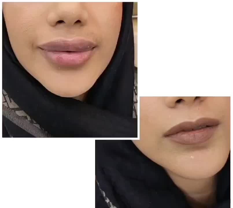 بوتاکس ژل لیفت نخ صورت بینی بلفاروپلاستی فیلر چرب|خدمات آرایشگری و زیبایی|اصفهان, مولوی|دیوار