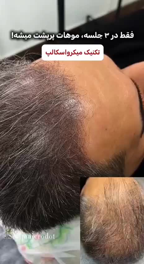 میکرو اسکالپ پوشش کم‌پشتی مو با رنگدانه|خدمات آرایشگری و زیبایی|تهران, حر|دیوار