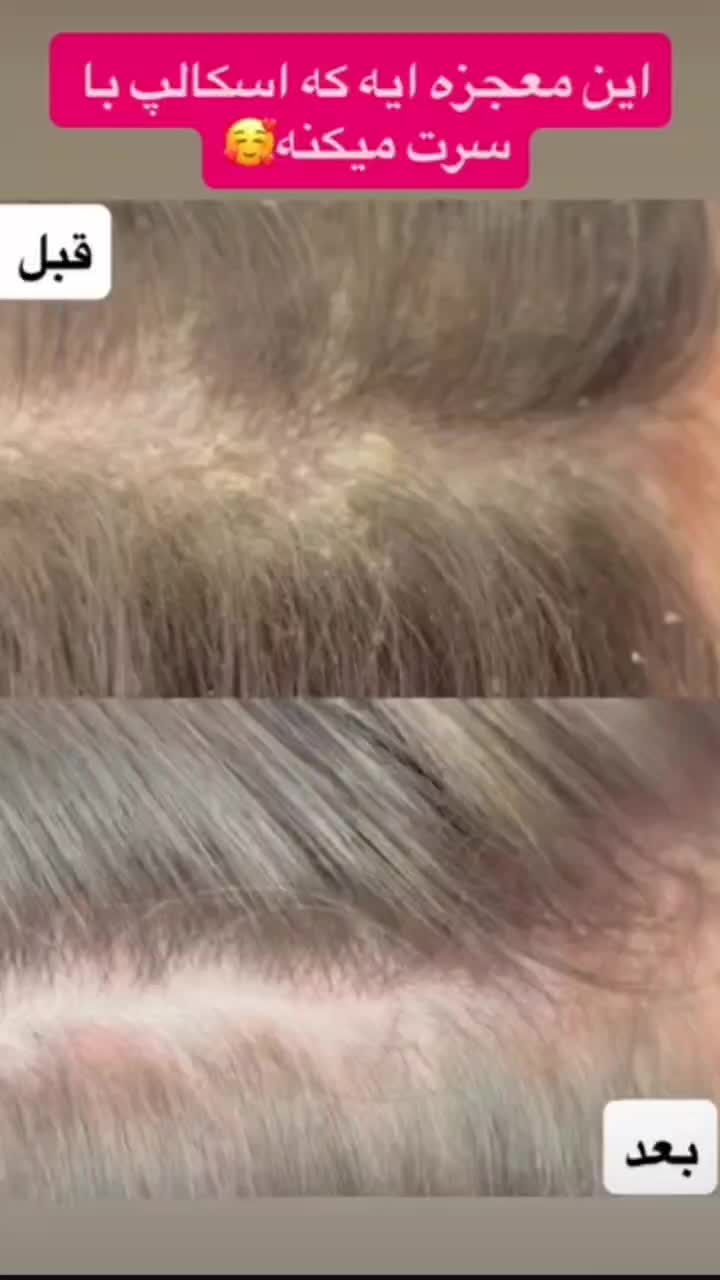 اسکراب اسکالپ تخصصی|خدمات آرایشگری و زیبایی|محمودآباد, |دیوار