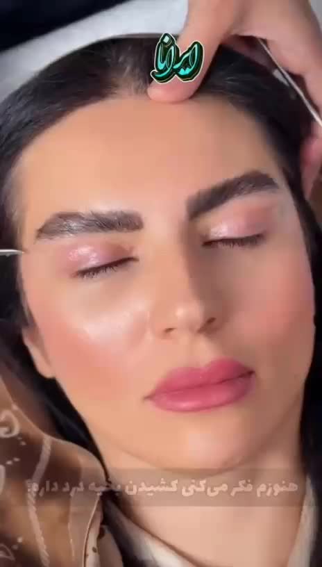 بلفاروبلاستی( جراحی پلک بدون رد بخیه)|خدمات آرایشگری و زیبایی|یاسوج, |دیوار