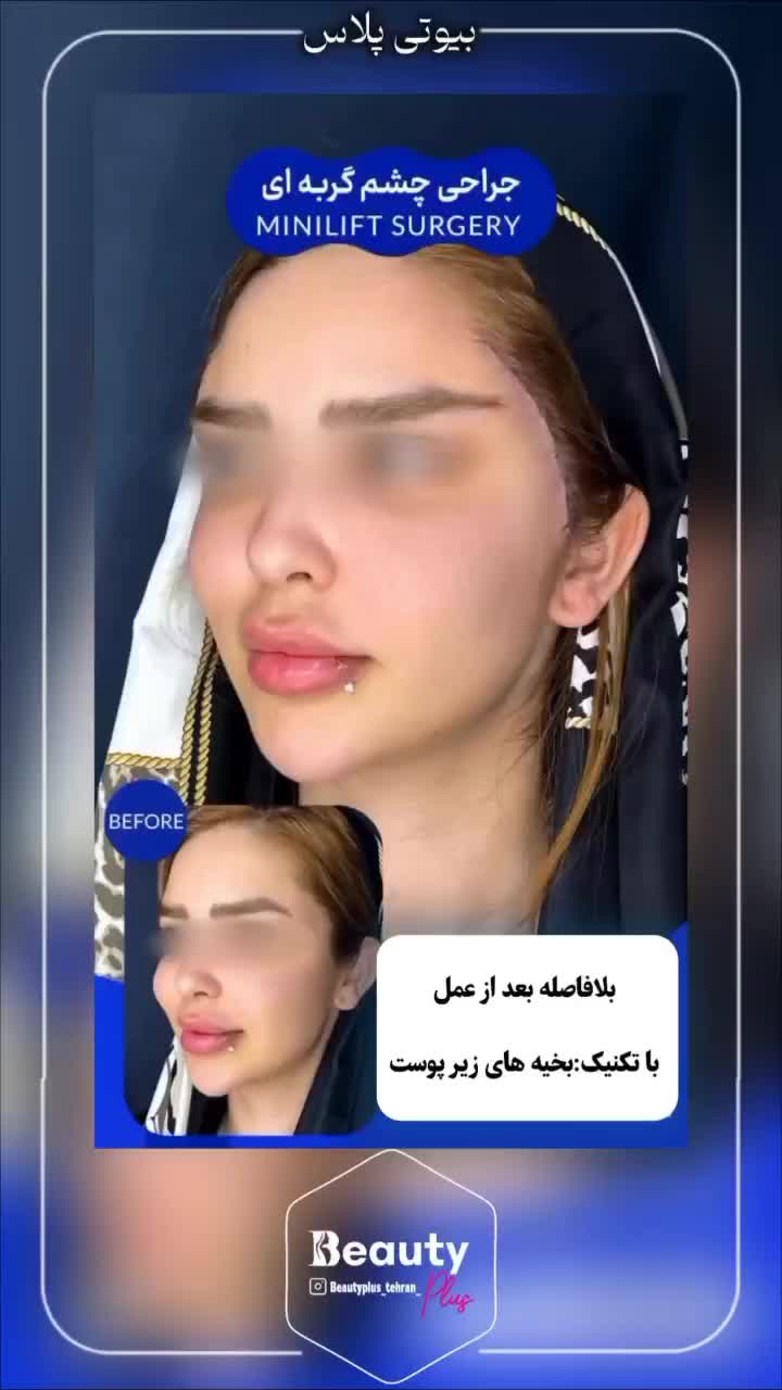 تخفیف ساکشن شکم پهلو و پشت/ هر ناحیه از بدن/بلفارو|خدمات آرایشگری و زیبایی|قم, زنبیل آباد|دیوار