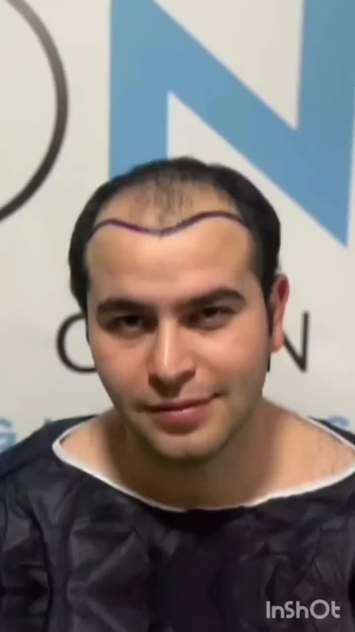 کاشت مو تارِنو|خدمات آرایشگری و زیبایی|خرم‌آباد, |دیوار