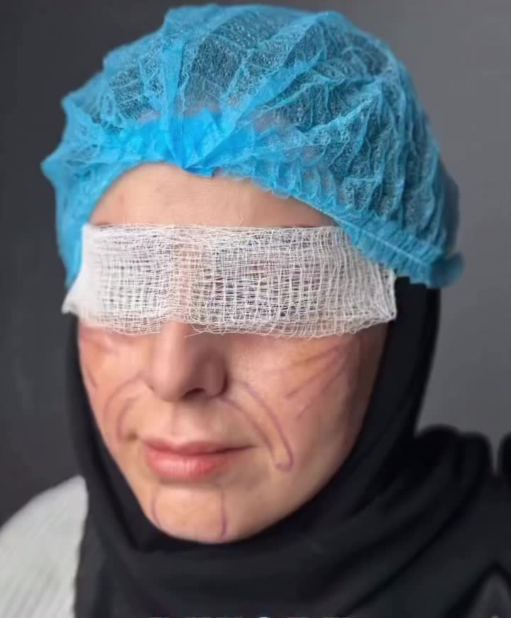 بوتاکس خطوط پیشانی و اخم رایگان‌ شد|خدمات آرایشگری و زیبایی|قم, هفت تیر|دیوار