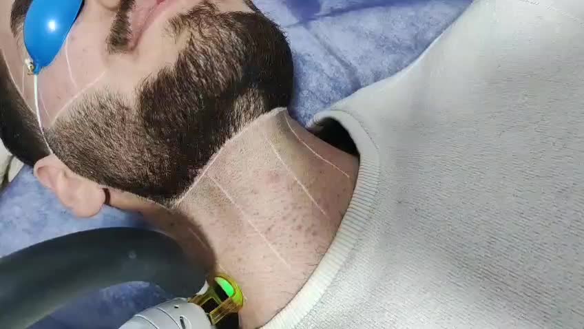 آف ویژه لیزر موهای زاید آلکساندرایت کندلا|خدمات آرایشگری و زیبایی|یاسوج, |دیوار