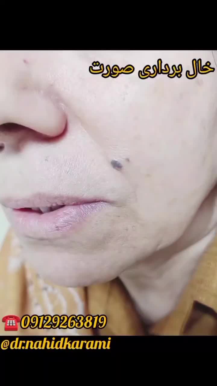 حذف خال زگیل و میخچه|خدمات آرایشگری و زیبایی|برازجان, |دیوار