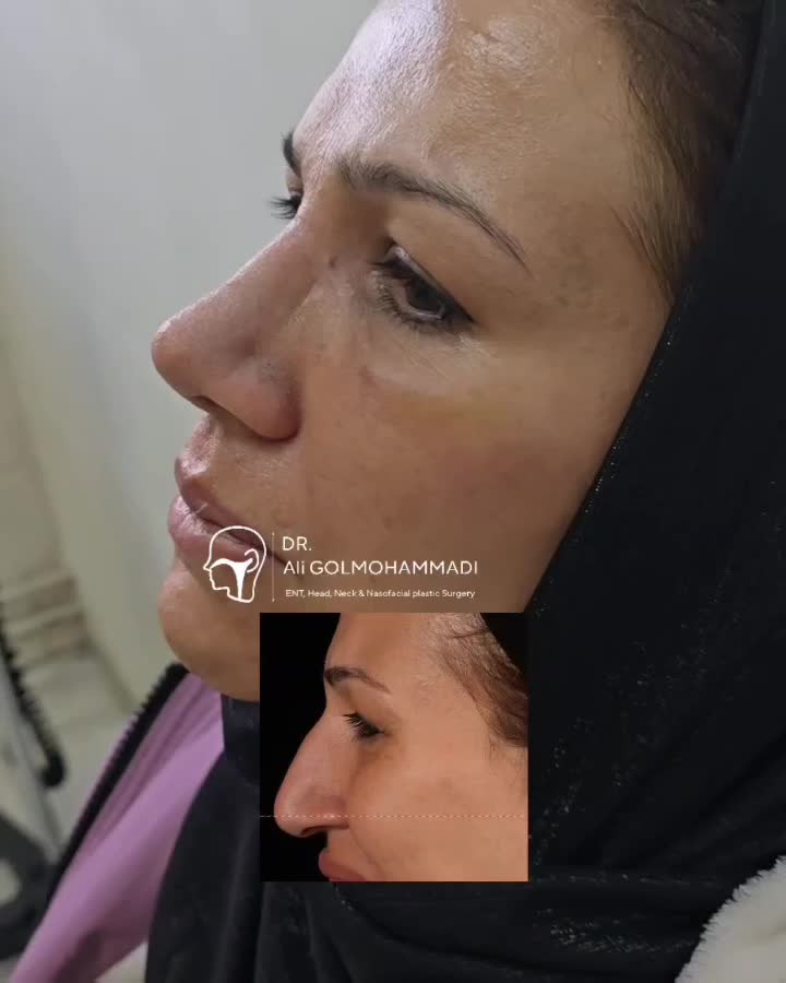 جراحی بینی و پلک، لیفت ابرو و شقیقه، لیفت صورت|خدمات آرایشگری و زیبایی|خوی, |دیوار