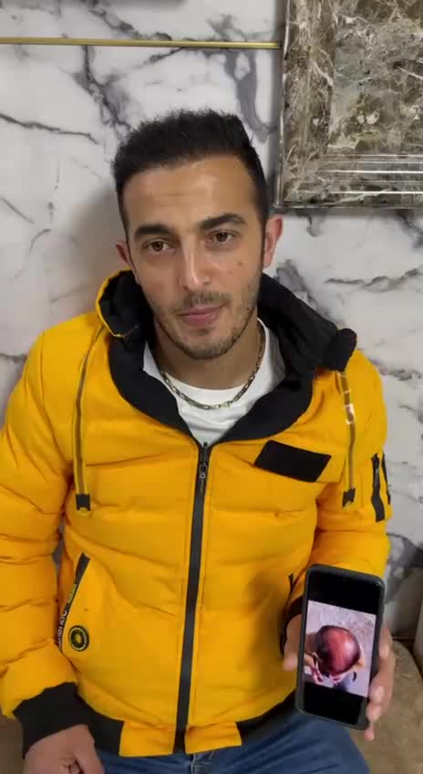 جشنواره کاشت مو ریش و ابرو|خدمات آرایشگری و زیبایی|مراغه, |دیوار