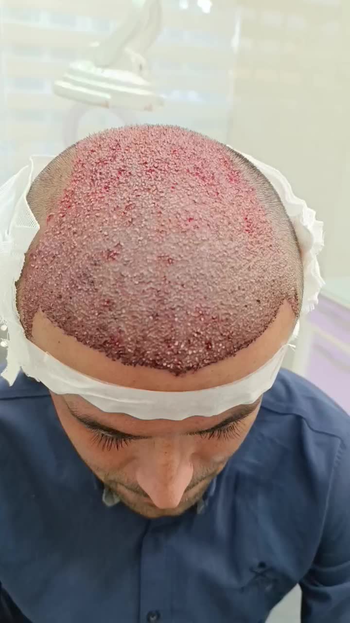 میخوای تضمینی باهزینه کمتر درشهر خودت کاشت مو کنی|خدمات آرایشگری و زیبایی|یزد, |دیوار