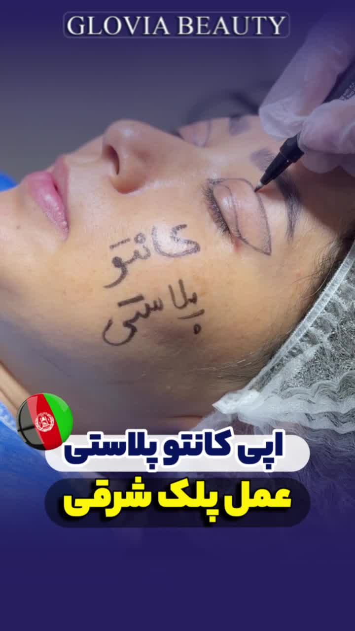 جراحی پلک ،بلفاروپلاستی ،لیفت شقیقه، جراحی زیبایی|خدمات آرایشگری و زیبایی|تهران, امانیه|دیوار
